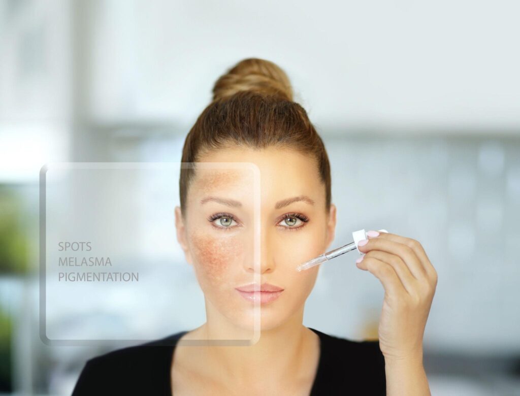 Understanding Hyperpigmentation and the Role of Hydroquinone in Achieving a More Even Complexion 4 image 3
